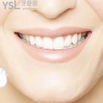 提供一份广州雅度口腔进口3m  p60树脂补牙价格表及顾客评价