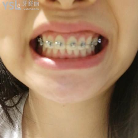 沈阳盛大口腔医院牙齿矫正（自锁托槽）多少钱？