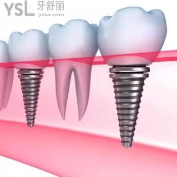 沈阳盛大口腔韩国进口植体全包价格表