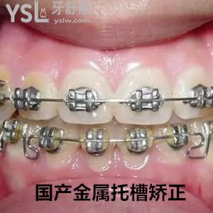 上海悦康口腔国产金属矫正对龅牙友好吗？价格贵吗？