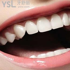 广州圣贝口腔树脂补牙价格贵吗？
