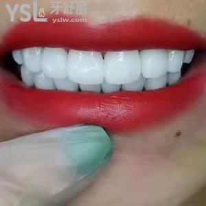 重庆成佳牙博士口腔医院价格之全瓷贴面多少钱？