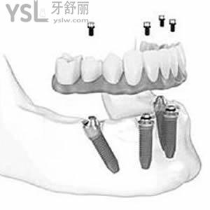 厦门登特口腔收费价格表安排上，其中包含种植牙和矫正的费用