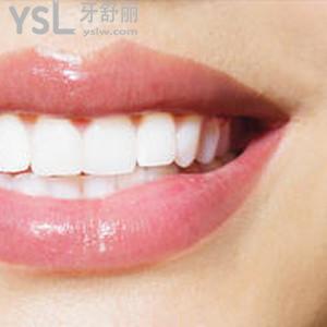 上海圣贝口腔之种植牙收费标准贵吗？上海圣贝口腔医院价目表强势来袭！