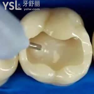 珠海九龙口腔医院价格贵吗？进口3M纳米树脂补牙价格优惠。