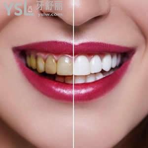 珠海九龙口腔医院收费标准，牙齿贴片全瓷贴面优惠价格活动。
