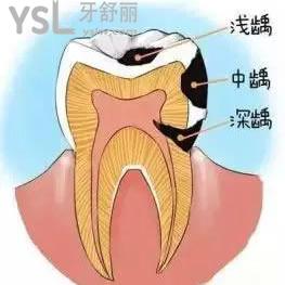 郑州拜博口腔医院价格贵吗？美国3M纳米树脂补牙活动价可一点都不贵。