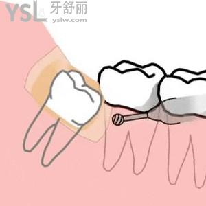 国产氧化锆全瓷牙冠价格，氧化锆全瓷牙和二氧化锆全瓷牙有什么区别？
