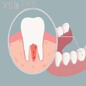 牙周炎是整个牙还是一颗牙，牙周炎严重可以做全口义齿吗？