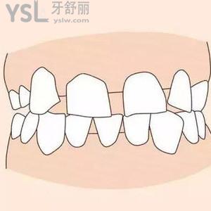 中年人牙齿越来越稀是什么原因