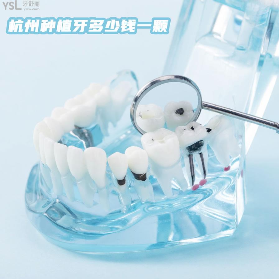 杭州种植牙多少钱一颗，还想知道杭州种牙哪家医院好
