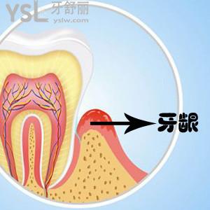 老年人牙龈萎缩怎么安假牙，好的方法有吗？