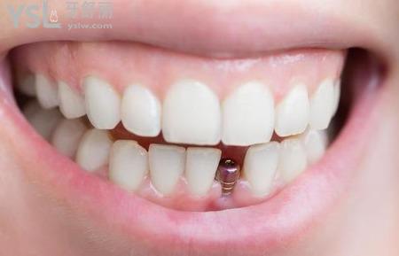 即刻种植牙和普通种植牙的区别？