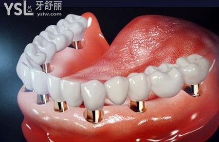 口中有种植牙还能做正畸治疗吗？