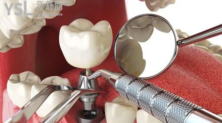 种植牙后邻牙痛的原因是什么？