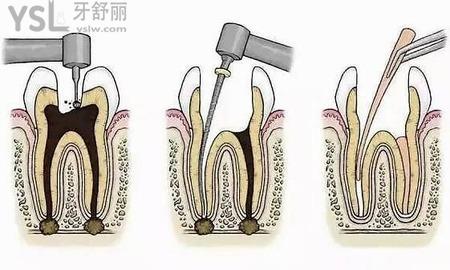 根管治疗要多少钱？