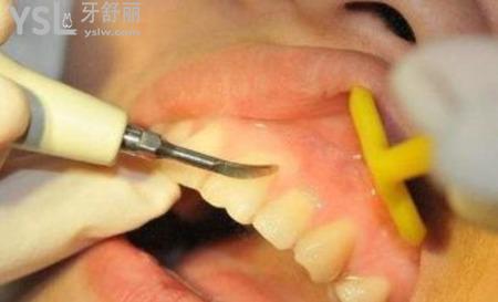 牙齿根周炎是怎么引起的？