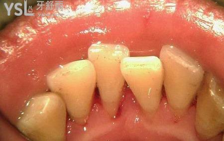 牙周疾病怎么治疗？