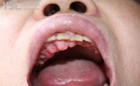 种植牙后牙龈增生正常吗？