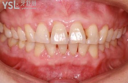 牙龈增生手术前做什么准备？