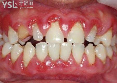 牙龈增生切除会很痛吗？