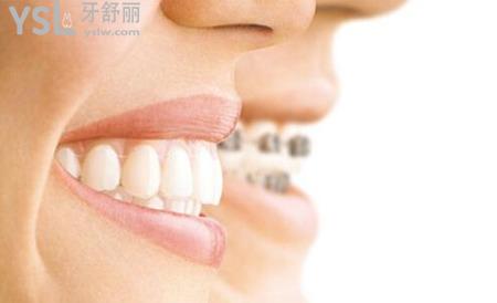 一般牙齿正畸的年龄限制是多少？
