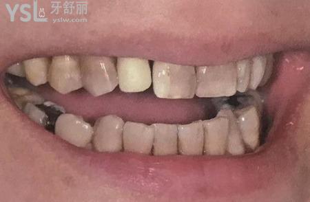 门牙瓷贴面能维持多久？