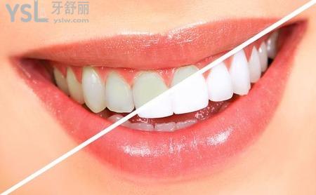 如何美白牙齿最有效？
