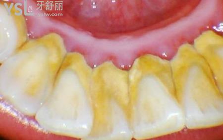 怎么防止牙结石？