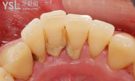 牙结石的危害都有什么危害？