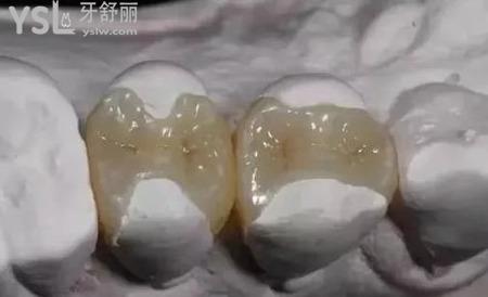 什么是牙齿嵌体修复？