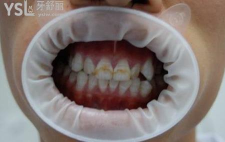 氟斑牙是怎么形成的？