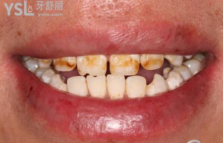 氟斑牙的特点是什么？