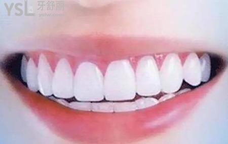牙性前突和骨性前突的区别在那？