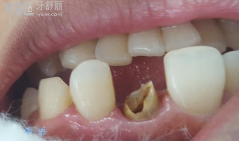 烂牙根十年了很臭怎么办？