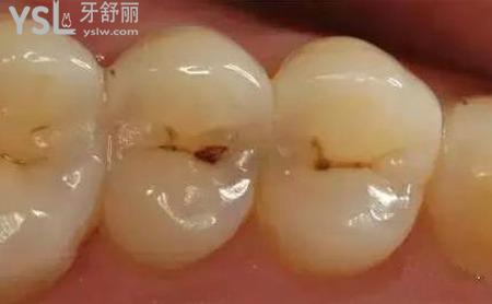 牙齿上有黑点是什么情况？