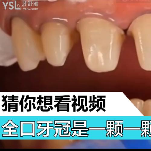 全口牙冠是一颗一颗的做的吗？