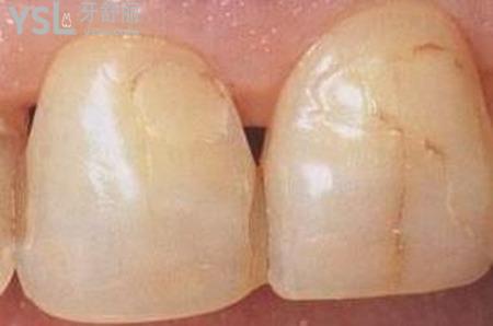 牙齿表面有黑线怎么办？
