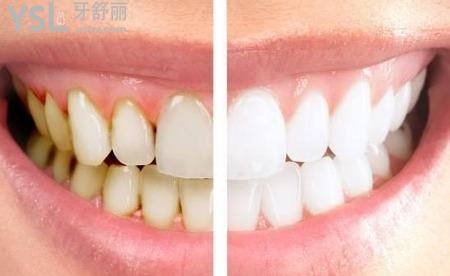 冷光美白牙齿的害处有哪些？