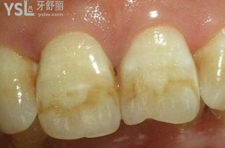 石斑牙怎么治疗？