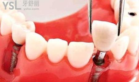哪种假牙伤害最小？