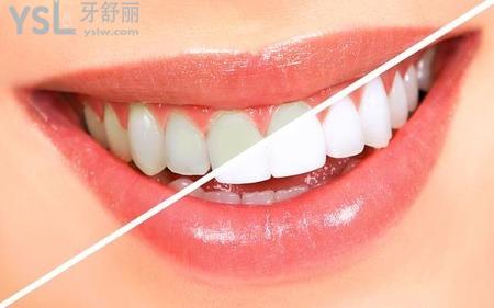 牙齿美白有害健康吗？