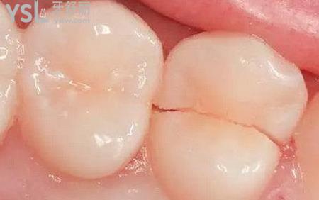 牙齿有裂缝怎么办？