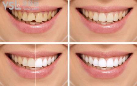 什么是牙齿贴面修复？
