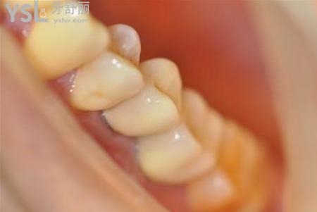 戴活动假牙的注意事项有哪些？