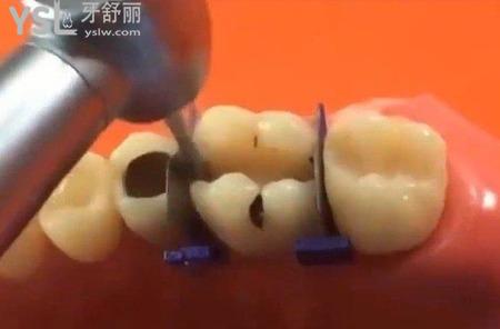 牙齿缝隙里很臭怎么回事？