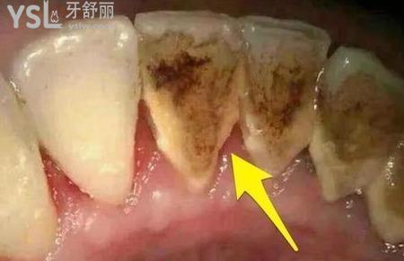 牙结石用什么牙膏比较好？
