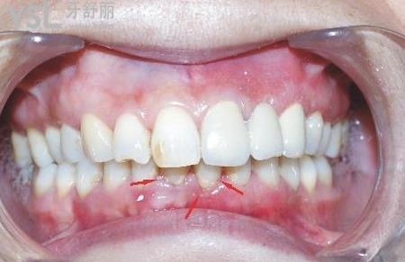 牙龈肿痛化脓怎么办？