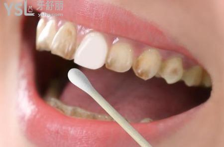 牙齿黄有什么办法？