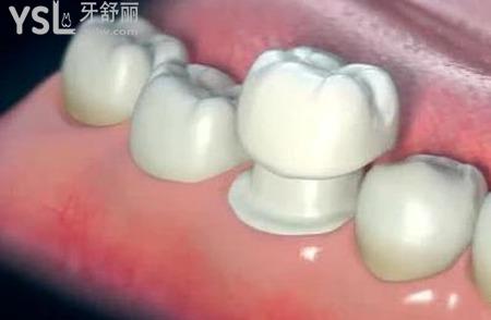 做了牙冠的牙疼正常吗？